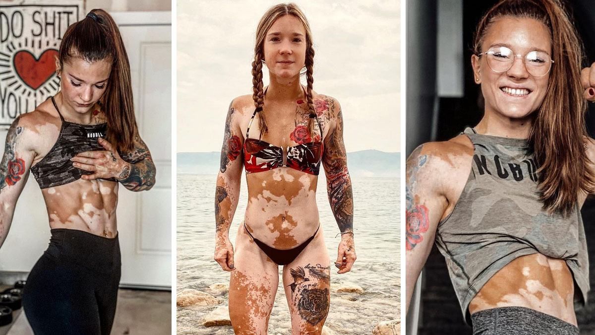 Как принять свое тело: невероятная история фитнес-тренерки, страдающей на витилиго Как принять свое тело: невероятная история фитнес-тренерки, страдающей на витилиго