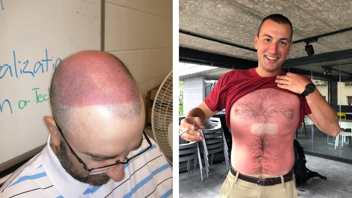 Короли загара: 10 людей, которым не повезло неудачно сгореть на солнце Короли загара: 10 людей, которым не повезло неудачно сгореть на солнце