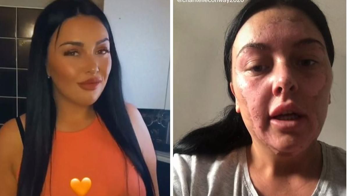 Женщина решила нестандартно сварить яйцо пашот: она попала в больницу Женщина решила нестандартно сварить яйцо пашот: она попала в больницу