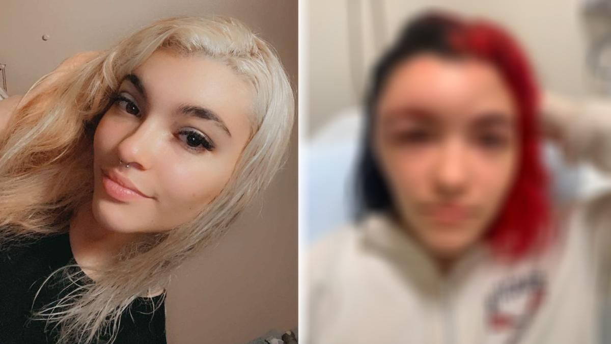 Дівчина невдало пофарбувала волосся: у неї серйозно спухло обличчя – фото Дівчина невдало пофарбувала волосся: у неї серйозно спухло обличчя – фото