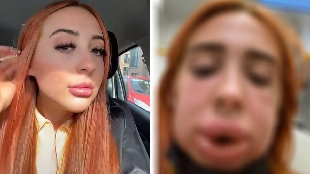 Блогерка невдало збільшила свої губи: як змінилося її обличчя