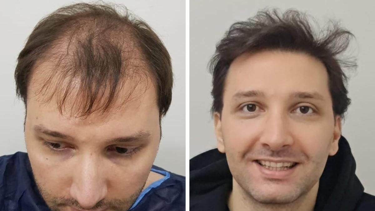 10 чоловіків, які успішно побороли облисіння: цікаві перевтілення - Life 10 чоловіків, які успішно побороли облисіння: цікаві перевтілення - Life