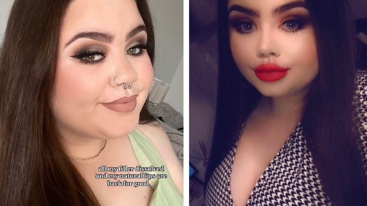 Закачала в губы 7 миллилитров: как сейчас выглядит девушка - Life Закачала в губы 7 миллилитров: как сейчас выглядит девушка - Life