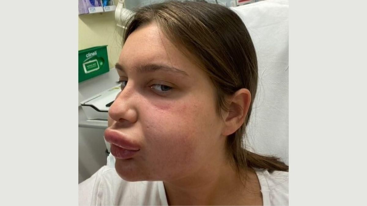 Девушка очень неудачно уменьшила губы: фото "после" шокировали сеть - Life