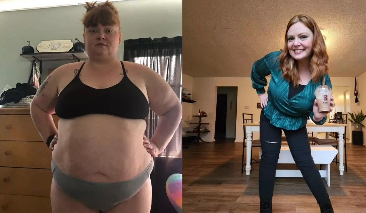 Для схуднення жінка зробила операцію зі зменшення шлунку Для схуднення жінка зробила операцію зі зменшення шлунку