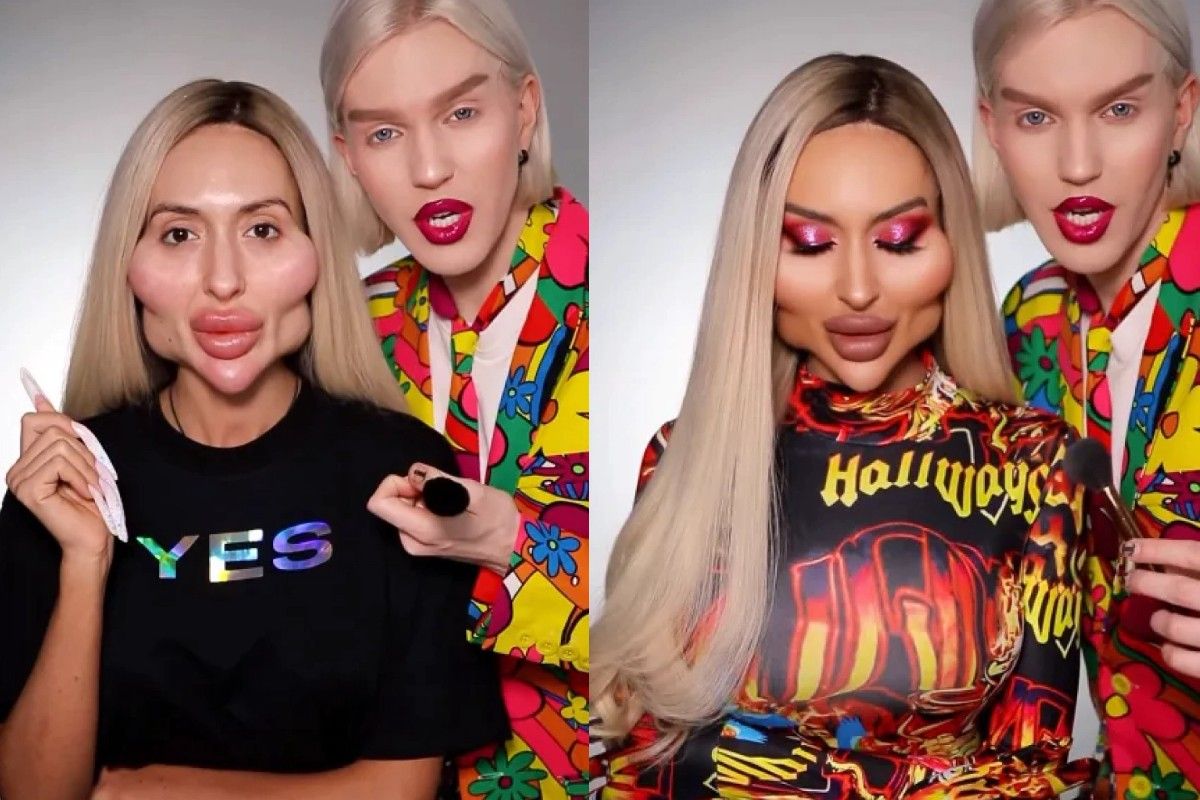 Жінка має найбільщі вилиці у світі Жінка має найбільщі вилиці у світі