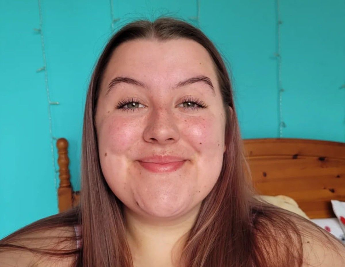 Девушка имеет редкую болезнь Девушка имеет редкую болезнь