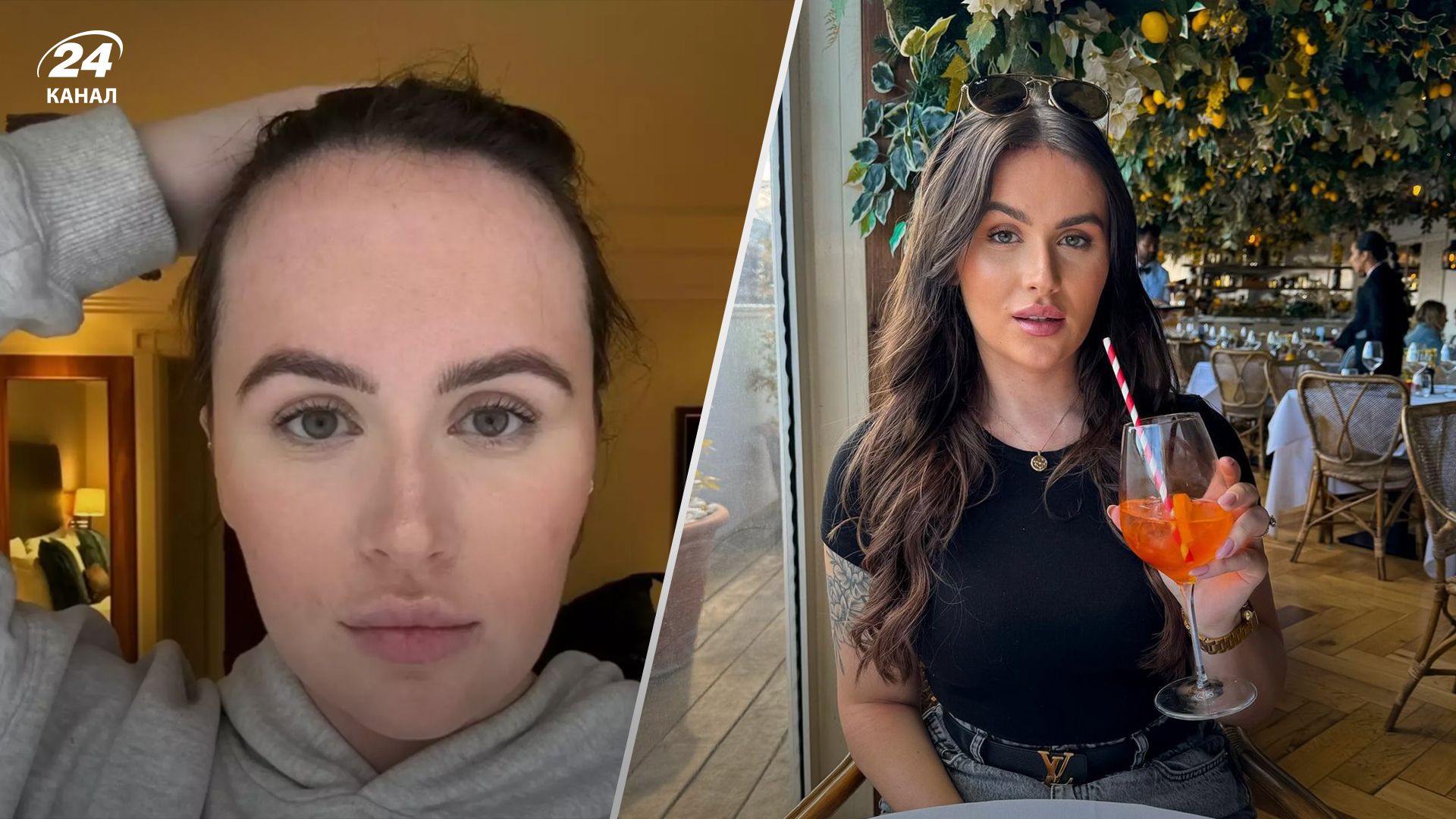 Девушка уменьшила лоб на несколько сантиметров Девушка уменьшила лоб на несколько сантиметров