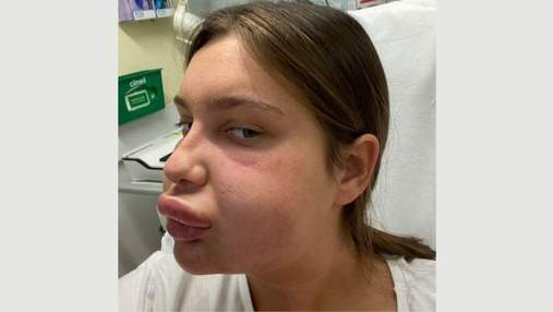 Девушка очень неудачно уменьшила губы: фото "после" шокировали сеть